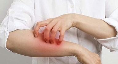 Uyuz Hastalığı neden olur? Uyuz hastalığı belirtileri ve tedavisi