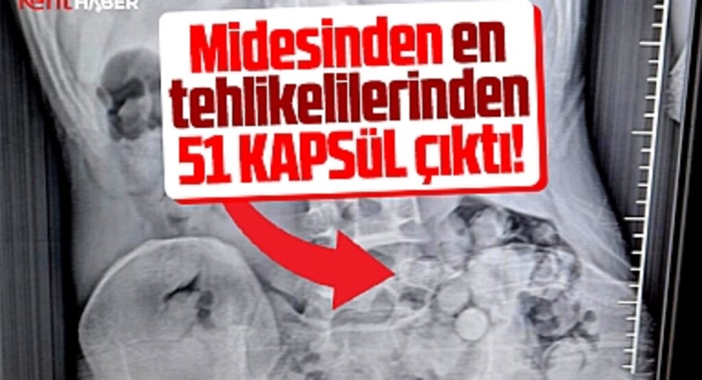Samsun'da şoke eden röntgen! Midesinden 51 kapsül çıktı!