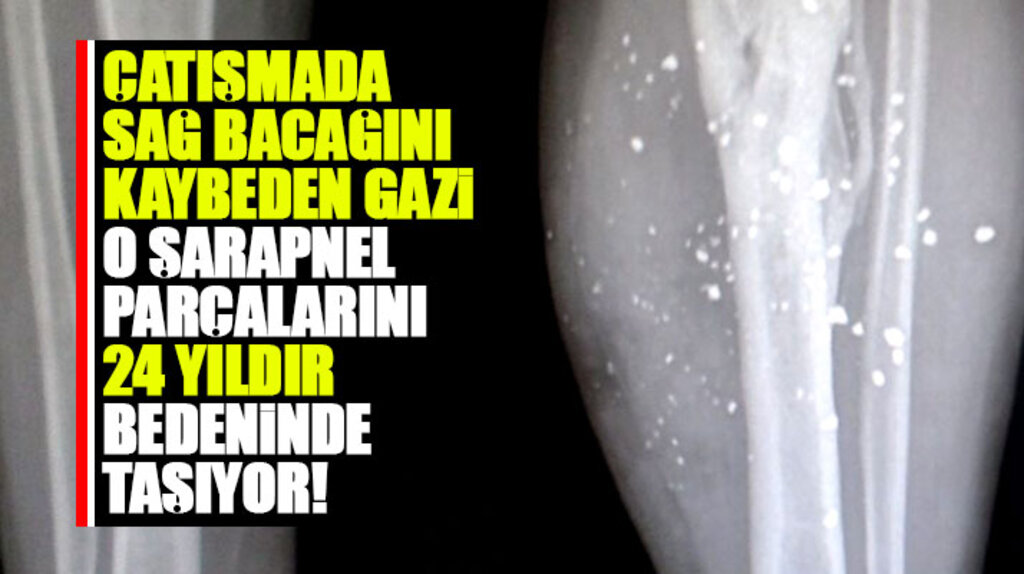 Samsun'da gazi polis Hasan Yıldız 24 yıldır sol bacağında kalan şarapnel parçaları ile yaşıyor